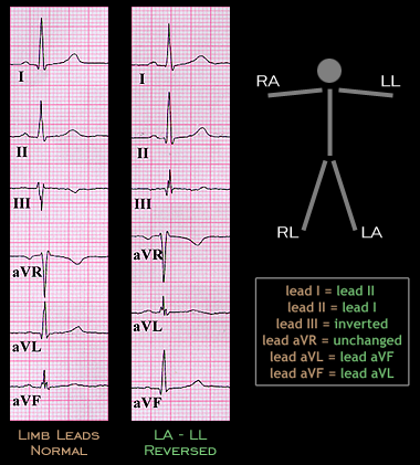 2.3.44 | Understanding the Electrocardiogram