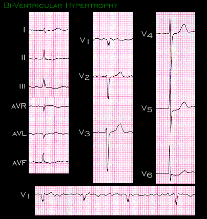 Biventricular Hypertrophy Litfl Ecg Library Diagnosis