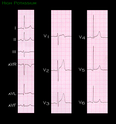 5.2.0 High Potassium (9) | Understanding the Electrocardiogram